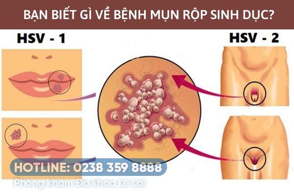 Nhận biết bệnh mụn rộp ở bộ phận sinh dục