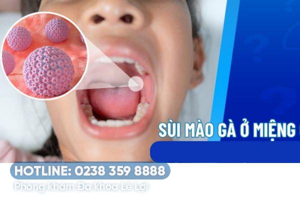 Thời gian ủ bệnh sùi mào gà ở miệng bao lâu?