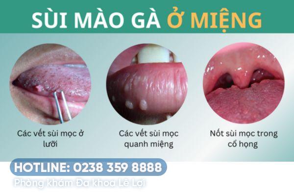 Cách chữa bệnh sùi mào gà vùng miệng tiên tiến