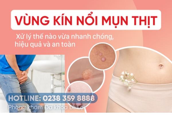 Những cách chữa mụn thịt ở vùng kín hiệu quả