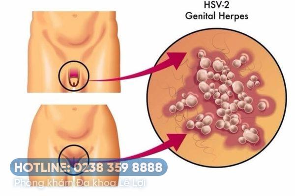 Nhận biết bệnh Herpes sinh dục nữ