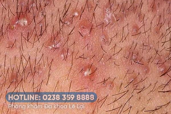 Nổi mụn mủ âm đạo điều trị thế nào?