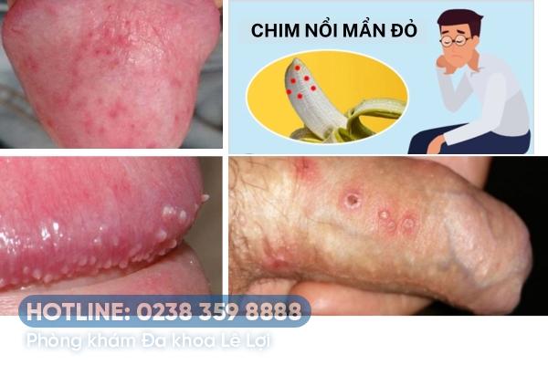 Chim nổi mẩn đỏ là bị gì?