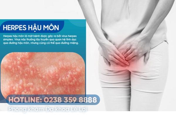 Herpes hậu môn là gì? Triệu chứng, nguyên nhân và cách chữa