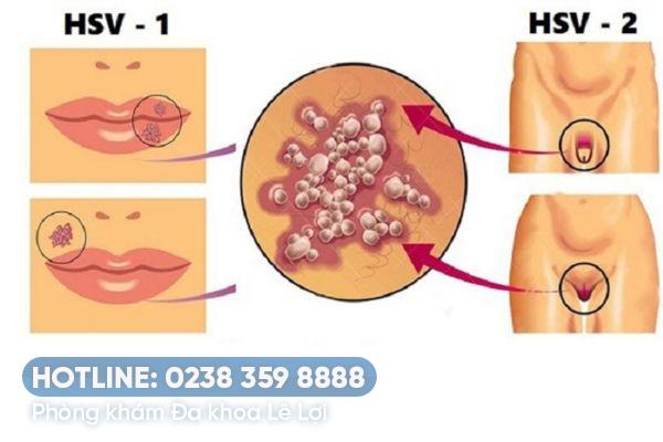 Dấu hiệu nhận biết Herpes vùng kín