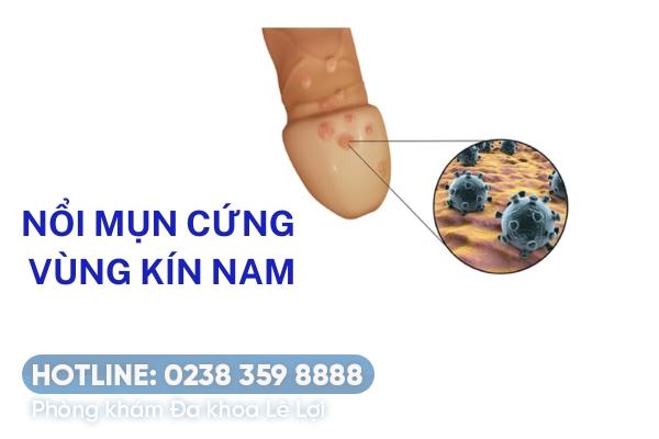 Mụn cứng vùng kín nam là bệnh gì điều trị thế nào?