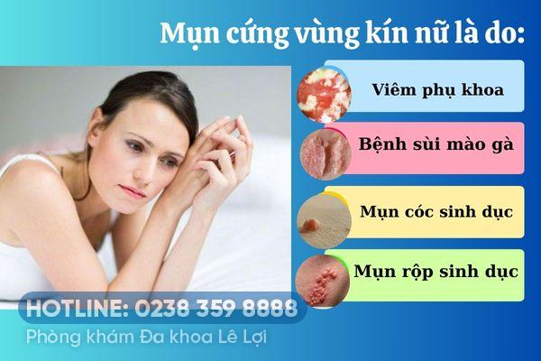 Mụn cứng vùng kín nữ và cách điều trị hiệu quả