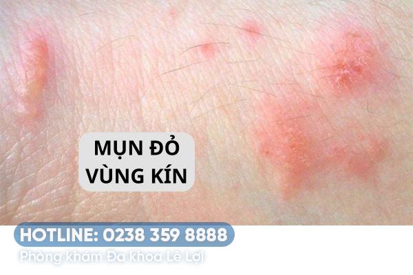 Nguyên nhân gây mụn đỏ vùng kín thường gặp