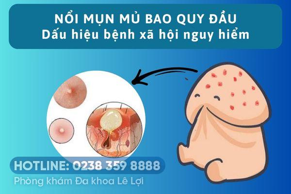 Nổi mụn mủ bao quy đầu là do đâu?