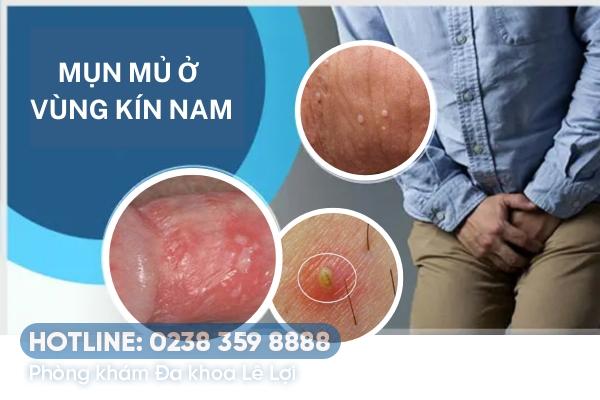 Nổi mụn mủ ở vùng kín nam phải làm sao?