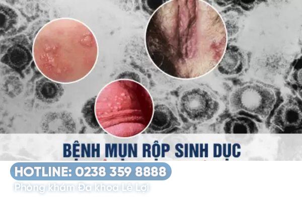 Mụn sinh dục nguy hiểm không?