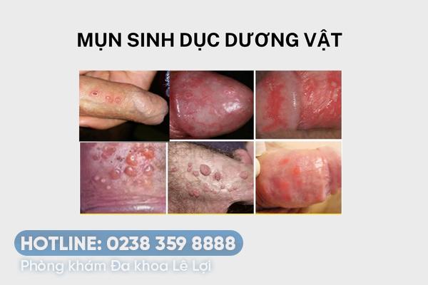 Mụn sinh dục dương vật nguyên nhân và cách điều trị