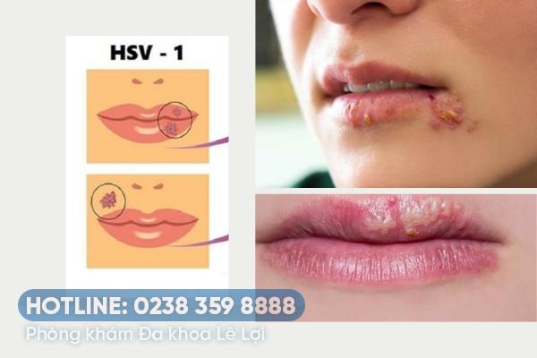 Dấu hiệu bệnh herpes môi và cách điều trị