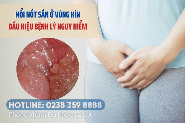 Cảnh giác với tình trạng nổi nốt sần vùng kín