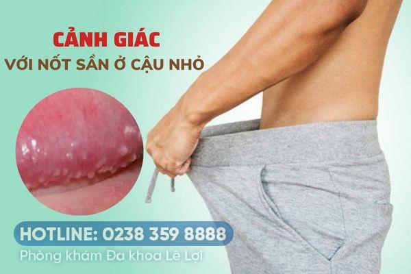 Nốt sần ở cậu nhỏ là bị bệnh gì?