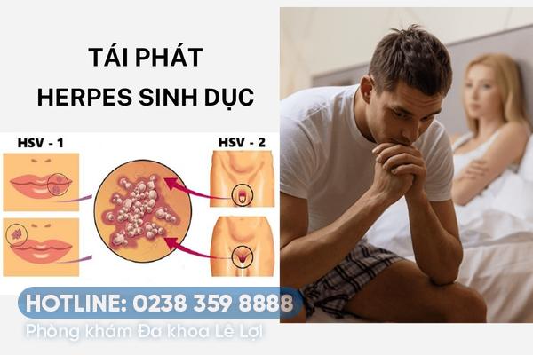 Nguyên nhân tái phát herpes sinh dục