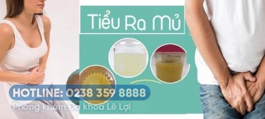 Tiểu ra mủ trắng là bị gì?