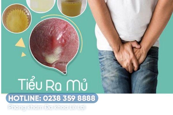 Tiểu ra mủ ở nam là dấu hiệu bệnh nguy hiểm