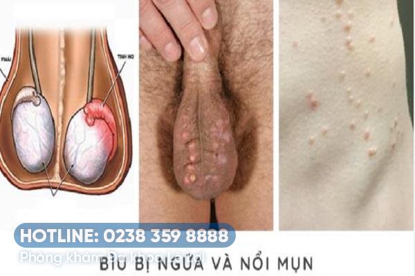 Chỉ ra lý do nổi mụn cứng ở bìu